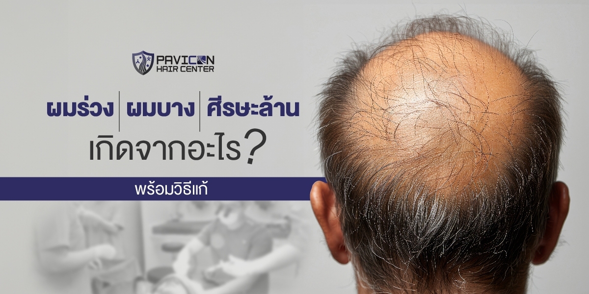 ผมร่วง-ผมบาง-ศีรษะล้าน เกิดจากอะไร? พร้อมวิธีแก้  