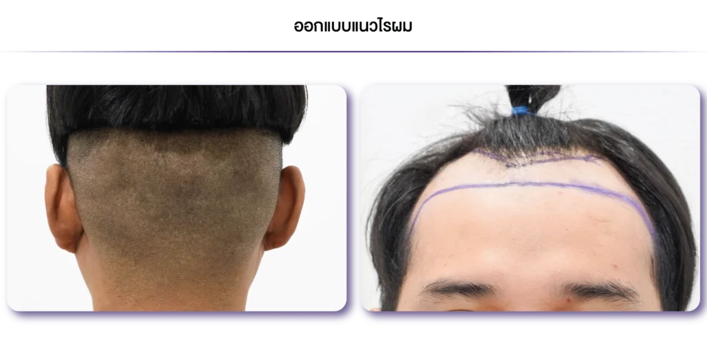FUE-ออกแบบแนวไรผม-01