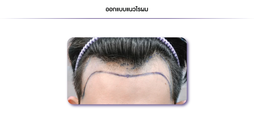 Review-AMF-ออกแบบแนวไรผม-02