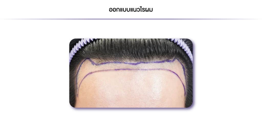 Review-DHI-ออกแบบแนวไรผม-03