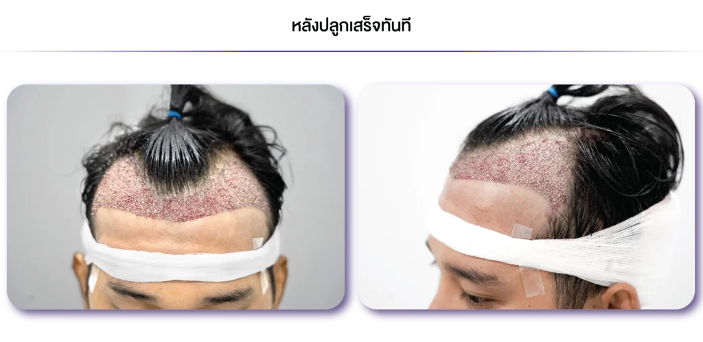 Review-FUE-ทันที-09